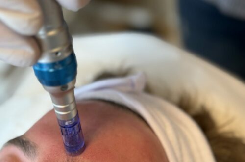 Microneedling hos Kosmetolog: En effektiv behandling til fornyelse af huden