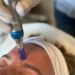 Microneedling hos Kosmetolog: En effektiv behandling til fornyelse af huden