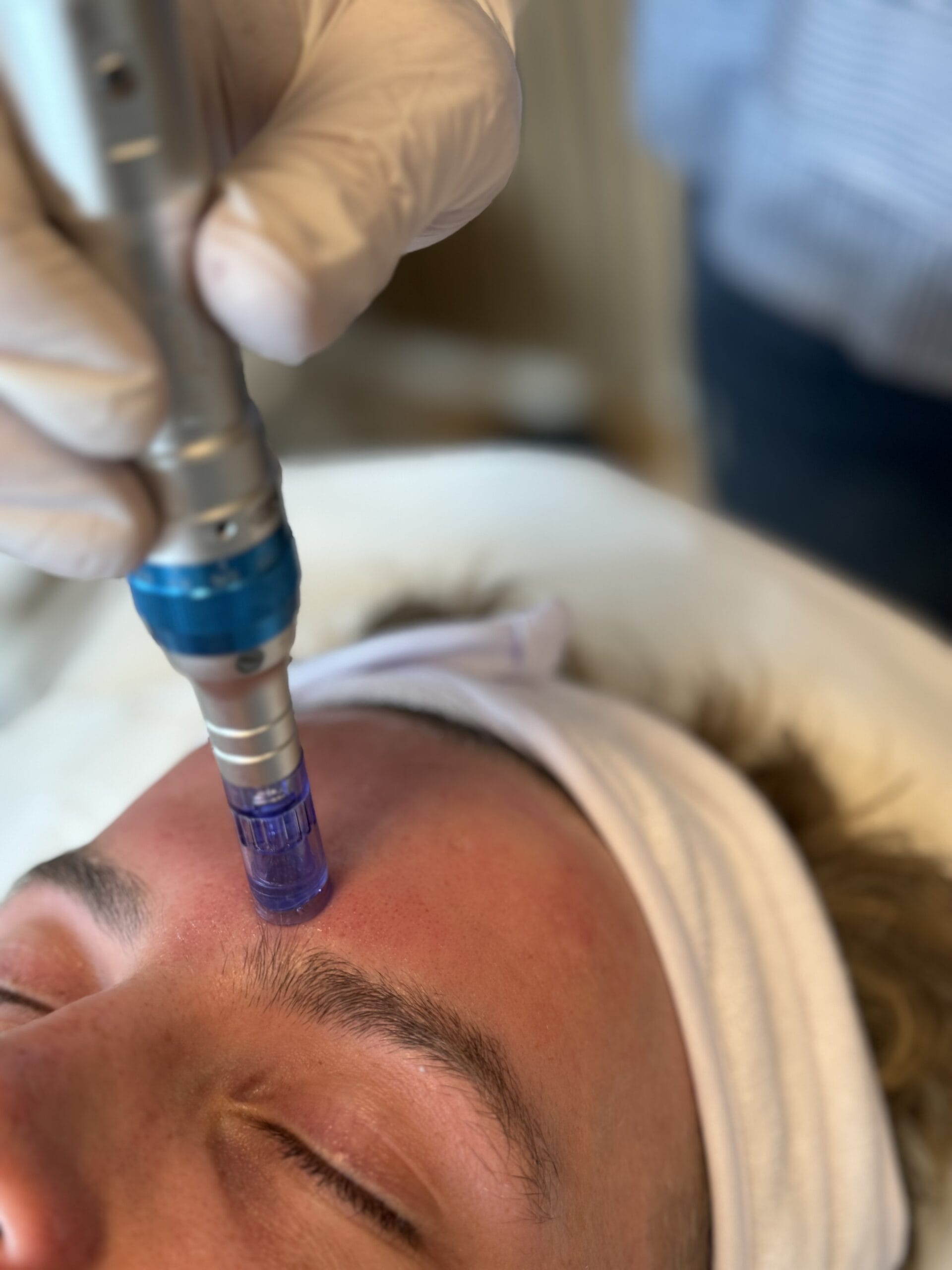 Microneedling hos Kosmetolog: En effektiv behandling til fornyelse af huden